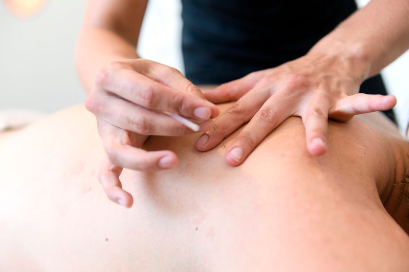 Person som utför akupunktur och sätter en tunn nål i ryggen på en patient.